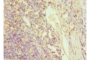 Immunohistochemistry of paraffin-embedded human colon cancer using ABIN7154393 at dilution of 1:100 (Granulin antibody  (AA 20-310))