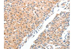 The image on the left is immunohistochemistry of paraffin-embedded Human breast cancer tissue using ABIN7128229(ADAM2 Antibody) at dilution 1/20, on the right is treated with fusion protein.
