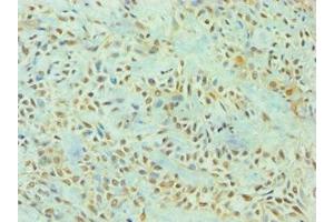 Immunohistochemistry of paraffin-embedded human breast cancer using ABIN7166926 at dilution of 1:100 (TP53I3 antibody  (AA 163-332))