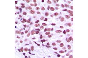Immunohistochemical analysis of MZF1 staining in human breast cancer formalin fixed paraffin embedded tissue section. (MZF1 antibody  (N-Term))