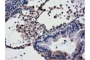 Immunohistochemical staining of paraffin-embedded Adenocarcinoma of Human breast tissue using anti-CYB5R3 mouse monoclonal antibody. (CYB5R3 antibody)