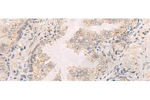 Immunohistochemistry of paraffin-embedded Human prost at e cancer tissue using TNNT1 Polyclonal Antibody at dilution of 1:35(x200) (TNNT1 antibody)