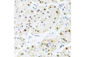 Immunohistochemistry of paraffin-embedded human stomach using BCCIP antibody at dilution of 1:100 (x40 lens). (BCCIP antibody)