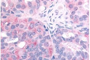 Human Ovarian Carcinoma (formalin-fixed, paraffin-embedded) stained with EGFR antibody ABIN213615 at 2. (EGFR antibody  (C-Term))