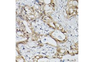 Immunohistochemistry of paraffin-embedded human lung cancer using ESE1/ELF3 Rabbit pAb (ABIN6130347, ABIN6140125, ABIN6140127 and ABIN6221990) at dilution of 1:150 (40x lens).