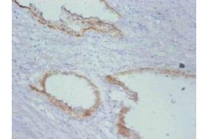 Immunohistochemistry of paraffin-embedded human prostate cancer using ABIN7172200 at dilution of 1:100 (TIMP1 antibody)