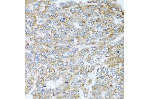 Immunohistochemistry of paraffin-embedded human liver cancer using NDUFA2 antibody at dilution of 1:100 (x40 lens). (NDUFA2 antibody)
