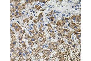 Immunohistochemistry of paraffin-embedded Human liver damage using NTF3 Polyclonal Antibody (Neurotrophin 3 antibody)
