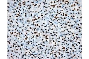 Immunohistochemical staining of paraffin-embedded Adenocarcinoma of colon tissue using anti-ARNT mouse monoclonal antibody.