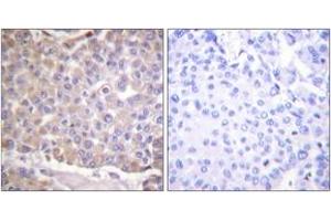 Immunohistochemistry analysis of paraffin-embedded human breast carcinoma tissue, using IRS-1 (Ab-1101) Antibody. (IRS1 antibody  (AA 1067-1116))