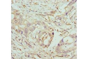 Immunohistochemistry of paraffin-embedded human pancreatic cancer using ABIN7148460 at dilution of 1:100