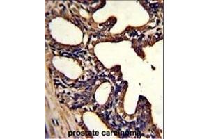 Formalin-fixed and paraffin-embedded human prostate carcinoma with LTF Monoclonal Antibody, which was peroxidase-conjugated to the secondary antibody, followed by DAB staining. (Lactoferrin antibody)