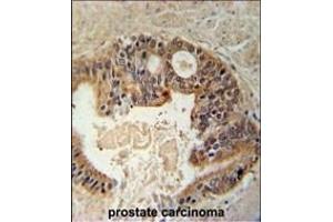 DYRK1A Antiboty (N-term) (ABIN391798 and ABIN2841652) immunohistochemistry analysis in formalin fixed and paraffin embedded human prostate carcinoma followed by peroxidase conjugation of the secondary antibody and DAB staining. (DYRK1A antibody  (N-Term))