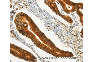 Immunohistochemistry of Human colon cancer using CHRDL2 Polyclonal Antibody at dilution of 1:20