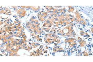 Immunohistochemistry of paraffin-embedded Human lung cancer using AUP1 Polyclonal Antibody at dilution of 1:50 (Ancient Ubiquitous Protein 1 antibody)