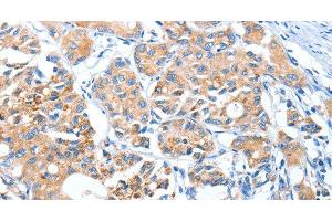 Immunohistochemistry of paraffin-embedded Human lung cancer using AUP1 Polyclonal Antibody at dilution of 1:50 (Ancient Ubiquitous Protein 1 antibody)