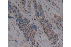 Used in DAB staining on fromalin fixed paraffin- embedded breast cancer tissue (HMGB3 antibody  (AA 14-176))