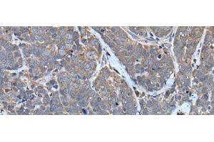 Immunohistochemistry of paraffin-embedded Human thyroid cancer tissue using TNMD Polyclonal Antibody at dilution of 1:40(x200) (TNMD antibody)