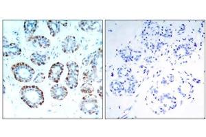 Immunohistochemical analysis of paraffin-embedded human breast carcinoma tissue, using BIM (Ab-65) antibody (E021280). (BIM antibody)