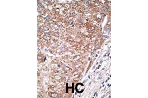 Formalin-fixed and paraffin-embedded human cancer tissue reacted with the primary antibody, which was peroxidase-conjugated to the secondary antibody, followed by DAB staining. (Nestin antibody  (C-Term))