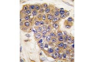 Formalin-fixed and paraffin-embedded human breast carcinoma tissue reacted with Puma BH3 Domain antibody (ABIN388112 and ABIN2846254) , which was peroxidase-conjugated to the secondary antibody, followed by DAB staining. (PUMA antibody  (AA 119-154))