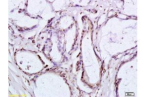 Formalin-fixed and paraffin embedded human colon carcinoma labeled with Anti-BRLF1 Polyclonal Antibody, Unconjugated (ABIN873254) at 1:200 followed by conjugation to the secondary antibody and DAB staining. (Protein Rta/BRLF1 antibody  (AA 81-180))