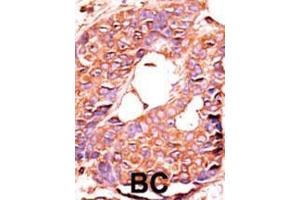 Formalin-fixed and paraffin-embedded human cancer tissue reacted with the primary antibody, which was peroxidase-conjugated to the secondary antibody, followed by AEC staining. (PPP6C antibody  (N-Term))