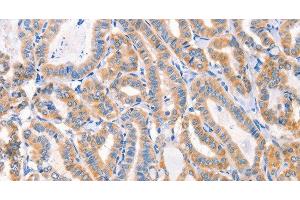 Immunohistochemistry of paraffin-embedded Human thyroid cancer tissue using Factor XIIIa Polyclonal Antibody at dilution 1:80 (F13A1 antibody)