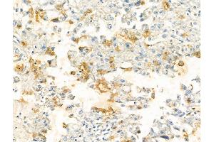 ABIN7094275 and ABIN7098322 at 1/100 staining Human liver cancer by IHC-P.