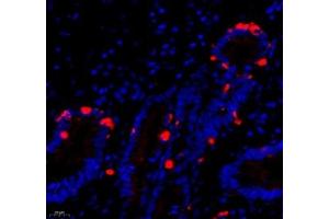 Immunofluorescence of paraffin embedded human gastric cancer using DCR3 (ABIN7076071) at dilution of 1: 700 (400x lens) (TNFRSF6B antibody)