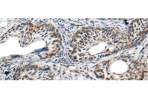 Immunohistochemistry of paraffin-embedded Human cervical cancer tissue using PRNP Polyclonal Antibody at dilution of 1:45(x200) (PRNP antibody)