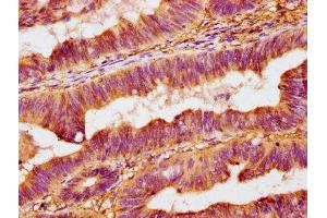 IHC image of ABIN7162317 diluted at 1:400 and staining in paraffin-embedded human colon cancer performed on a Leica BondTM system. (Osteomodulin antibody  (AA 339-411))
