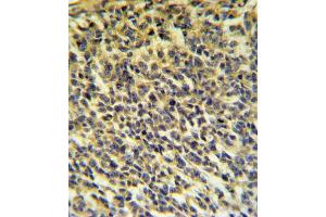 PLA2G6 Antibody IHC analysis in formalin fixed and paraffin embedded testis carcinoma followed by peroxidase conjugation of the secondary antibody and DAB staining. (PLA2G6 antibody  (AA 551-580))