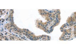 Immunohistochemistry of paraffin-embedded Human thyroid cancer tissue using VLDLR Polyclonal Antibody at dilution 1:40 (VLDLR antibody)