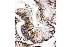 Anti-SOD2 antibody, IHC(P) IHC(P): Human Intestinal Cancer Tissue (SOD2 antibody  (N-Term))