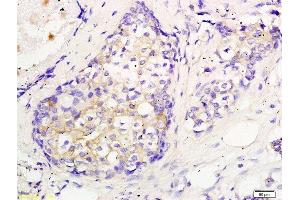 Formalin-fixed and paraffin embedded human breast cancer labeled with Anti CEP55 Polyclonal Antibody, Unconjugated  followed by conjugation to the secondary antibody and DAB staining