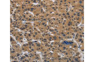 Immunohistochemistry of Human gastric cancer using CLDN2 Polyclonal Antibody at dilution of 1:50 (Claudin 2 antibody)