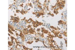 Immunohistochemistry of Human thyroid cancer using IDH3G Polyclonal Antibody at dilution of 1:30