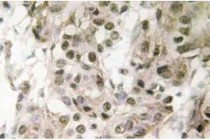 Immunohistochemistry (IHC) analyzes of Nucleophosmin antibody in paraffin-embedded human breast carcinoma tissue. (NPM1 antibody)