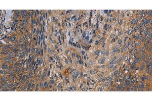 Immunohistochemistry of paraffin-embedded Human cervical cancer tissue using PARP10 Polyclonal Antibody at dilution 1:30 (PARP10 antibody)
