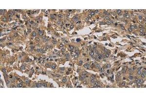 Immunohistochemistry of paraffin-embedded Human liver cancer using KIF22 Polyclonal Antibody at dilution of 1:30 (KIF22 antibody)