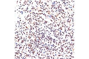 Immunohistochemistry of paraffin-embedded human breast cancer using P Rabbit mAb (ABIN7269156) at dilution of 1:100 (40x lens). (PAX9 antibody)