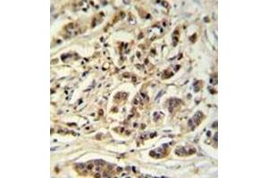 Immunohistochemistry analysis in formalin fixed and paraffin embedded breast carcinoma reacted with METT11D1 Antibody (N-term) followed which was followed by peroxidase conjugated to the secondary antibody and followed by DAB staining. (METTL17 antibody  (N-Term))