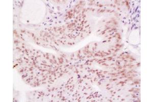 Formalin-fixed and paraffin embedded human endometrium tissue labeled with Anti-MLH-1 Polyclonal Antibody, Unconjugated  at 1:200, followed by conjugation to the secondary antibody and DAB staining (MLH1 antibody  (AA 501-600))