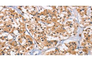 Immunohistochemistry of paraffin-embedded Human thyroid cancer tissue using EIF4EBP2 Polyclonal Antibody at dilution 1:40