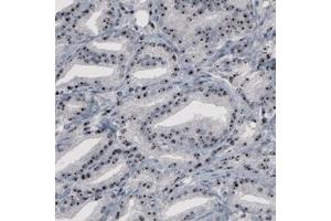 Immunohistochemical staining (Formalin-fixed paraffin-embedded sections) of human prostate cancer with NOP56 monoclonal antibody, clone CL2603  shows strong nucleolar positivity in glandular cells. (NOP56 antibody)
