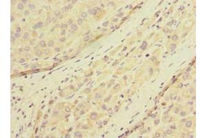 Immunohistochemistry of paraffin-embedded human liver cancer using ABIN7165883 at dilution of 1:100 (POMGNT1 antibody  (AA 59-300))