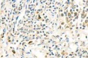 Immunohistochemistry (Paraffin-embedded Sections) (IHC (p)) image for anti-Poly (ADP-Ribose) Polymerase 1 (PARP1) (cleaved) antibody (ABIN7075114)
