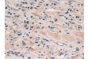 DAB staining on IHC-P; Samples: Human Prostate cancer Tissue (GSAP antibody  (AA 616-854))