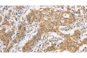 Immunohistochemistry of paraffin-embedded Human gasrtic cancer tissue using ITGB3BP Polyclonal Antibody at dilution 1:50 (ITGB3BP antibody)